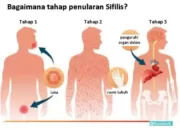 Mengenal Sifilis dan Upaya Pencegahan di Aceh
