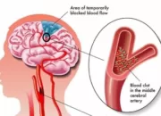 Stroke Salah Satu Penyakit Tidak Menular, Tapi Banyak Diderita Masyarakat