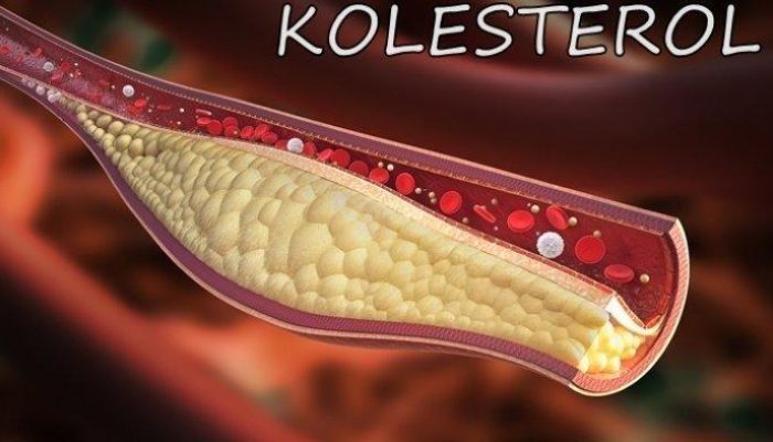 Waspada Lonjakan Kolesterol di Hari Raya Idul Fitri, Bisa Menyebabkan Stroke