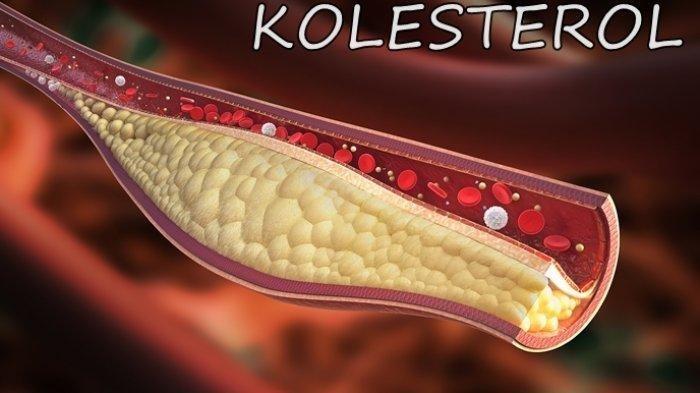 Waspada Lonjakan Kolesterol di Hari Raya Idul Fitri, Bisa Menyebabkan Stroke