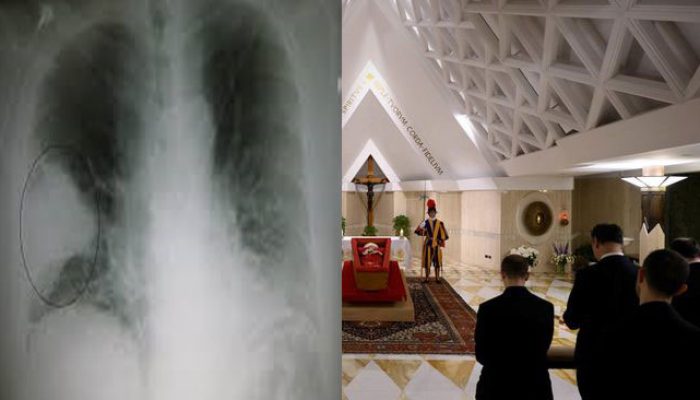 Paus Fransiskus Mati Setelah Berjuang Melawan Pneumonia Ganda, Penyakit Apa itu? Simak Disini